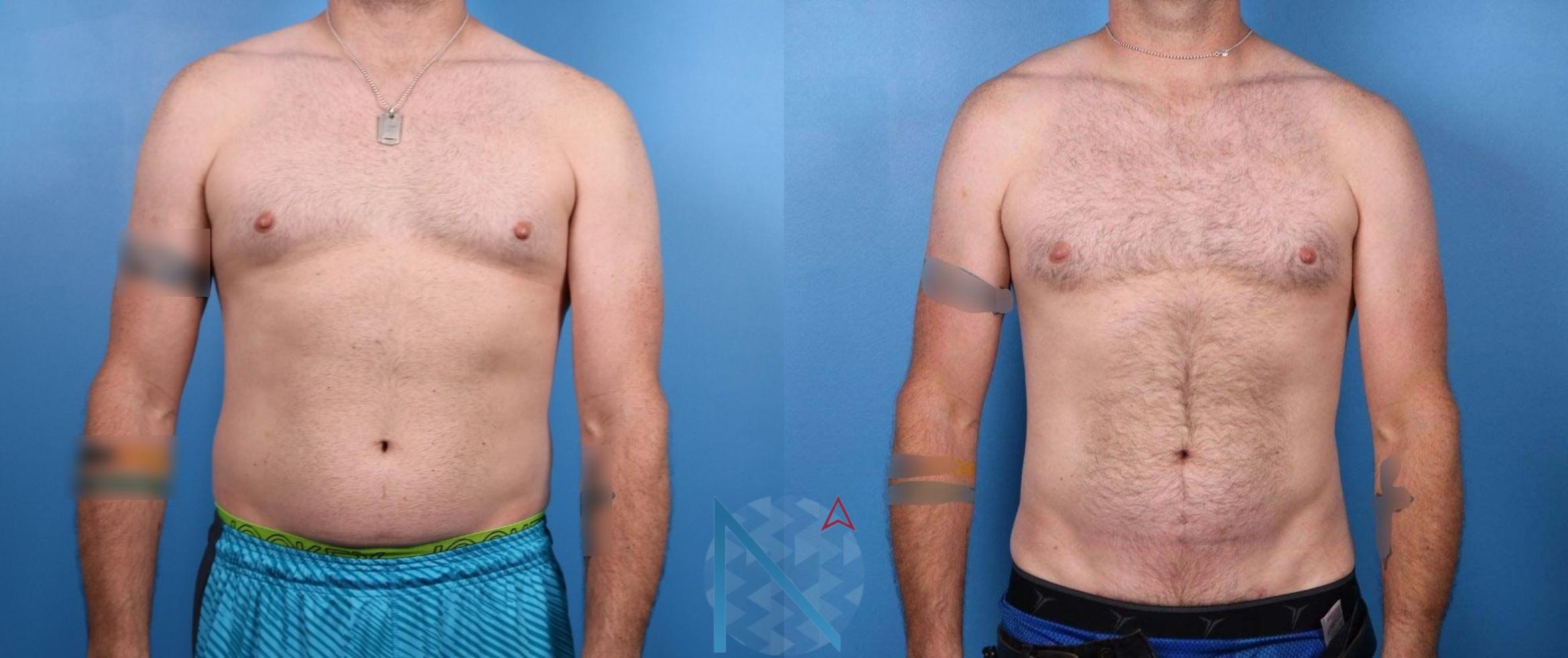 Before & After Male Liposuction Case 167 View 1 View in Raleigh, NC