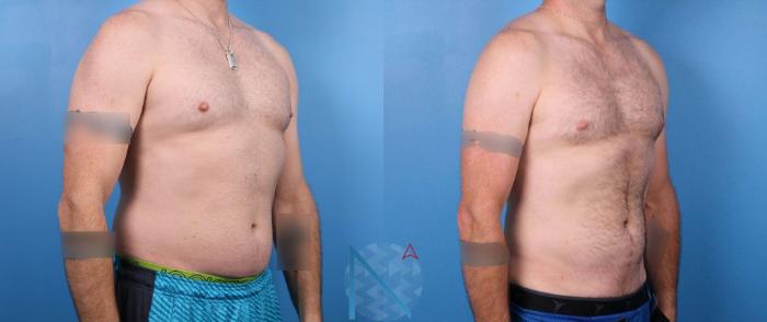 Before & After Male Liposuction Case 167 View 2 View in Raleigh, NC