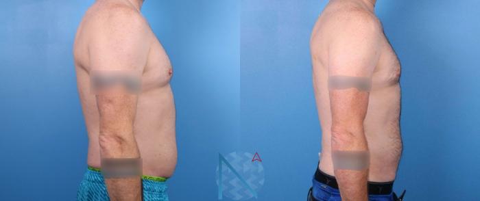 Before & After Male Liposuction Case 167 View 3 View in Raleigh, NC