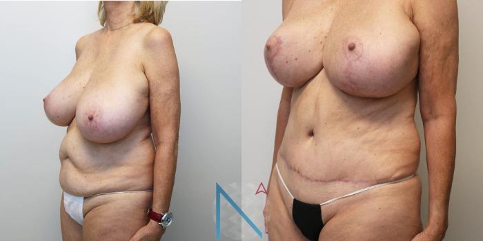 Before & After Meno Makeover Case 150 View 3 View in Raleigh, NC