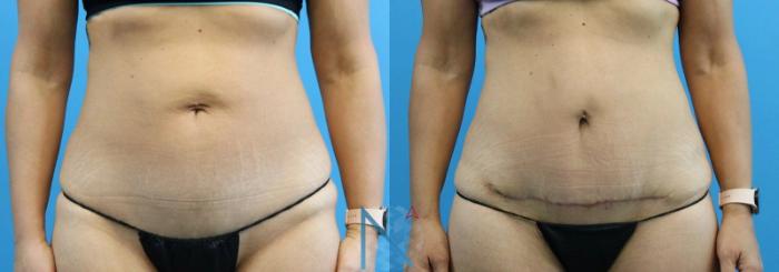 Before & After Mini Tummy Tuck Case 146 View 1 View in Raleigh, NC