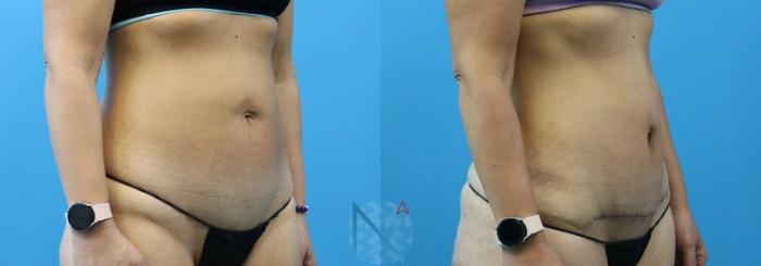 Before & After Mini Tummy Tuck Case 146 View 2 View in Raleigh, NC