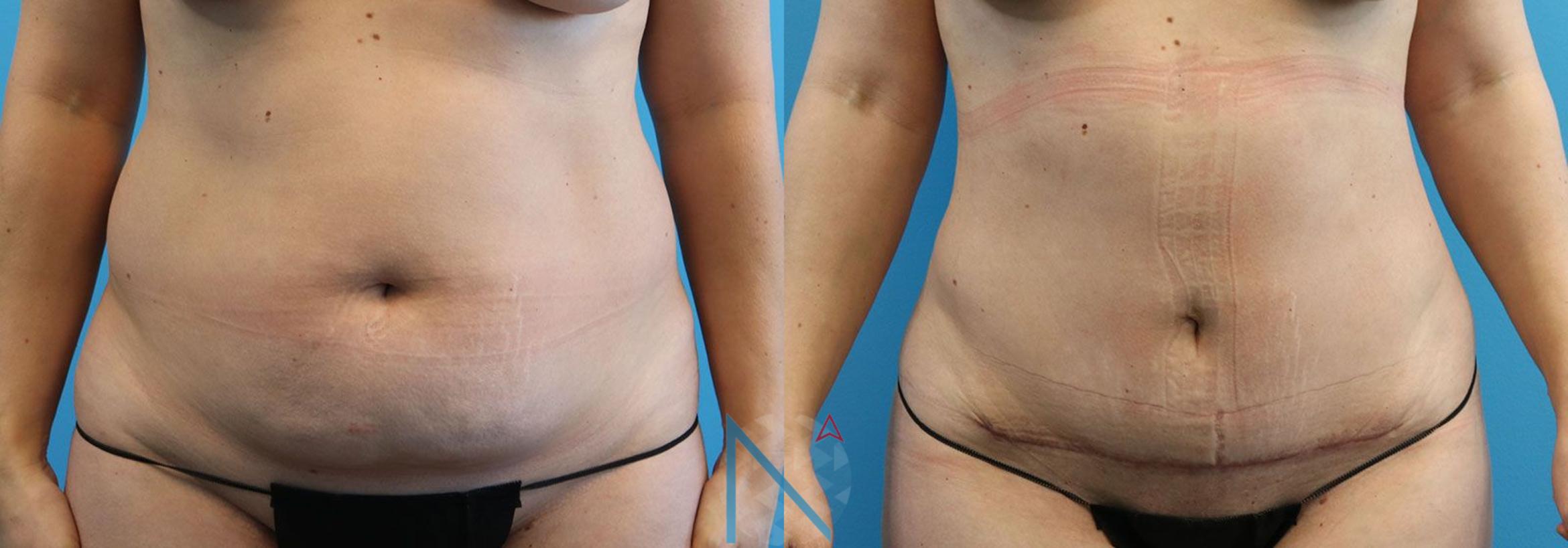 Before & After Mini Tummy Tuck Case 147 View 1 View in Raleigh, NC