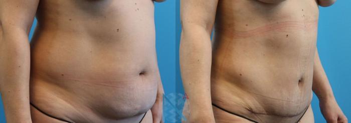 Before & After Mini Tummy Tuck Case 147 View 2 View in Raleigh, NC