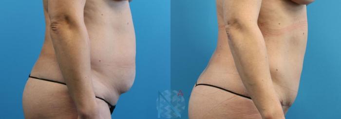 Before & After Mini Tummy Tuck Case 147 View 3 View in Raleigh, NC