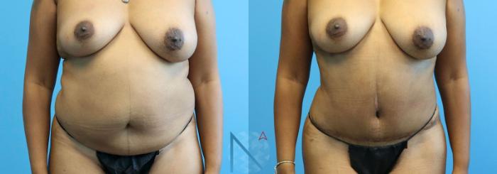 Before & After Mini Tummy Tuck Case 148 View 1 View in Raleigh, NC