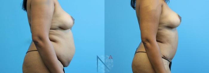 Before & After Mini Tummy Tuck Case 148 View 3 View in Raleigh, NC