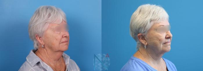 Before & After Neck Lift Case 160 View 2 View in Raleigh, NC