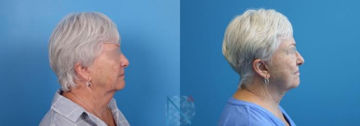 Before & After Neck Lift Case 160 View 3 View in Raleigh, NC