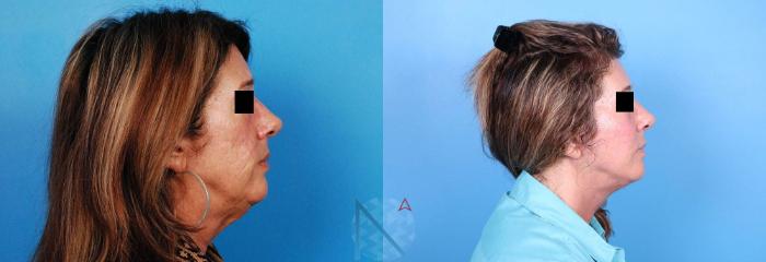 Before & After Neck Lift Case 161 View 3 View in Raleigh, NC