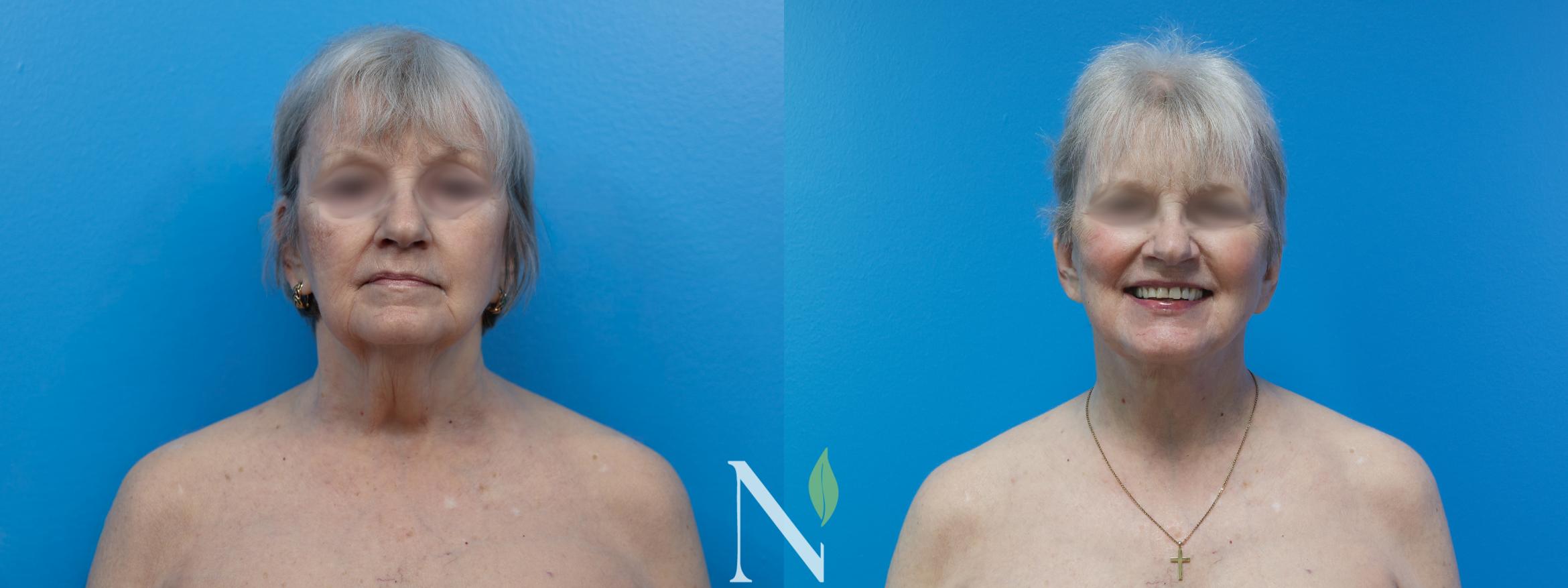 Before & After Neck Lift Case 186 Front View in Raleigh, NC
