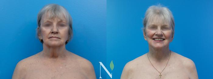 Before & After Neck Lift Case 186 Front View in Raleigh, NC