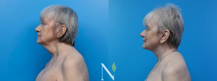 Before & After Neck Lift Case 186 Left Side View in Raleigh, NC