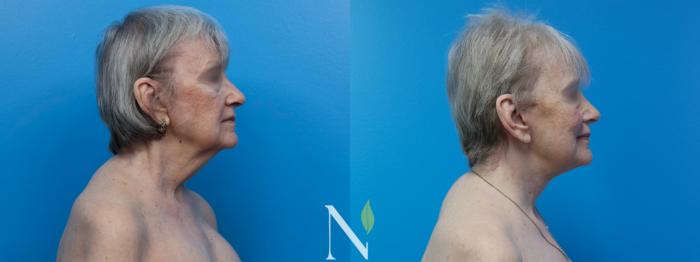 Before & After Neck Lift Case 186 Right Side View in Raleigh, NC