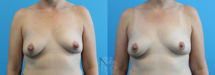 Before & After Nipple Reduction Case 81 View 1 View in Raleigh, NC