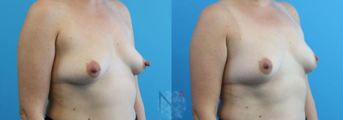 Before & After Nipple Reduction Case 81 View 2 View in Raleigh, NC