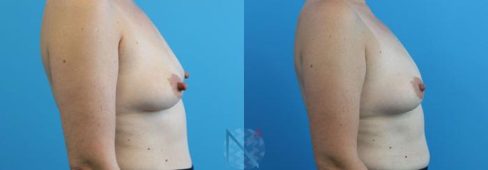 Before & After Nipple Reduction Case 81 View 3 View in Raleigh, NC