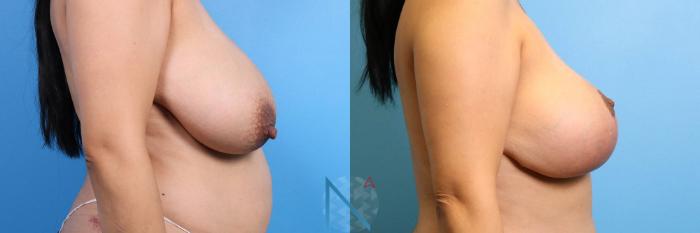 Before & After Nipple Reduction Case 82 View 3 View in Raleigh, NC