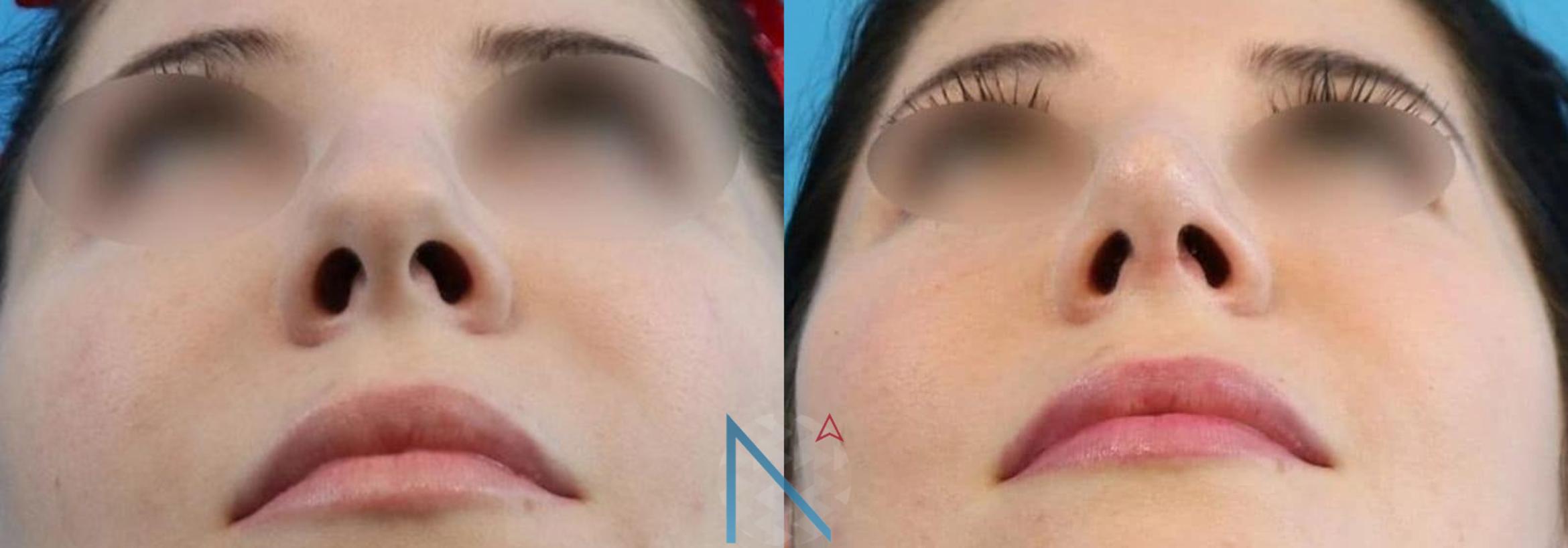 Before & After Rhinoplasty Case 157 View 1 View in Raleigh, NC