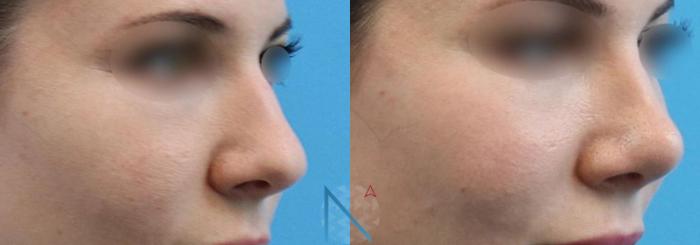 Before & After Rhinoplasty Case 157 View 2 View in Raleigh, NC