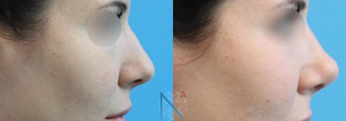 Before & After Rhinoplasty Case 157 View 3 View in Raleigh, NC