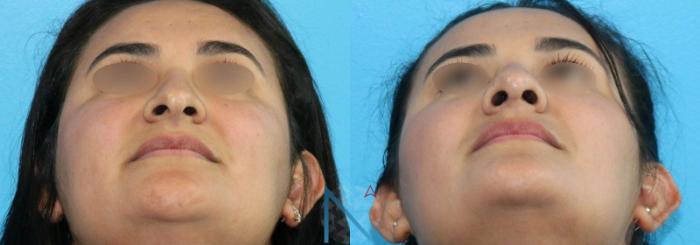 Before & After Rhinoplasty Case 158 View 1 View in Raleigh, NC