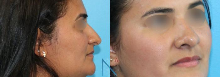 Before & After Rhinoplasty Case 158 View 2 View in Raleigh, NC