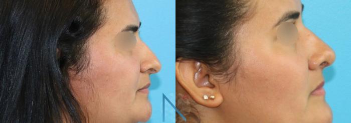 Before & After Rhinoplasty Case 158 View 3 View in Raleigh, NC