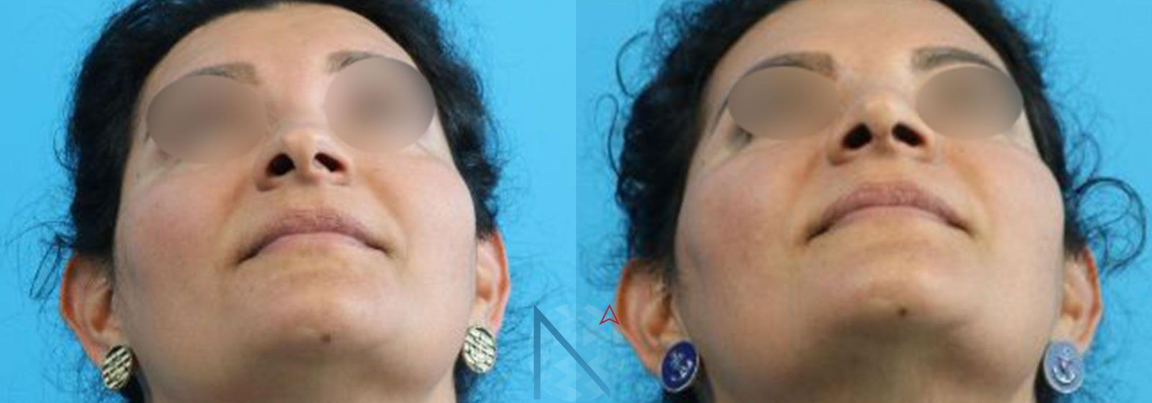 Before & After Rhinoplasty Case 159 View 1 View in Raleigh, NC