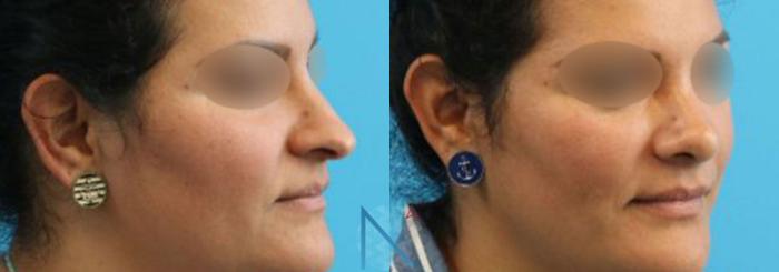 Before & After Rhinoplasty Case 159 View 2 View in Raleigh, NC