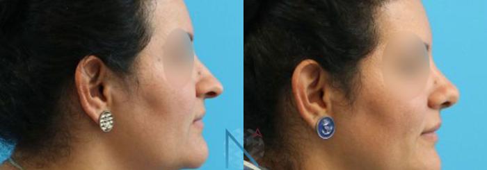 Before & After Rhinoplasty Case 159 View 3 View in Raleigh, NC