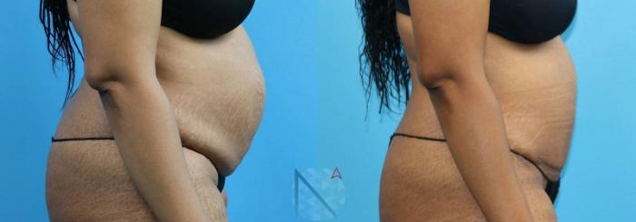 Before & After Tummy Tuck Case 119 View 3 View in Raleigh, NC