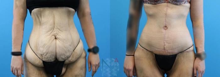 Before & After Tummy Tuck Case 120 View 1 View in Raleigh, NC