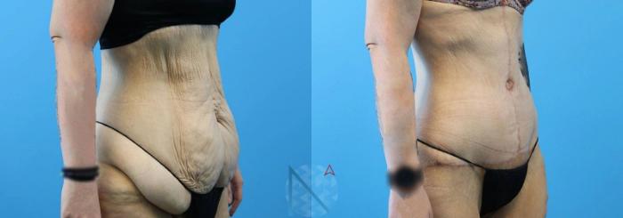 Before & After Tummy Tuck Case 120 View 2 View in Raleigh, NC