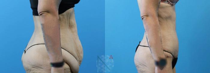 Before & After Tummy Tuck Case 120 View 3 View in Raleigh, NC