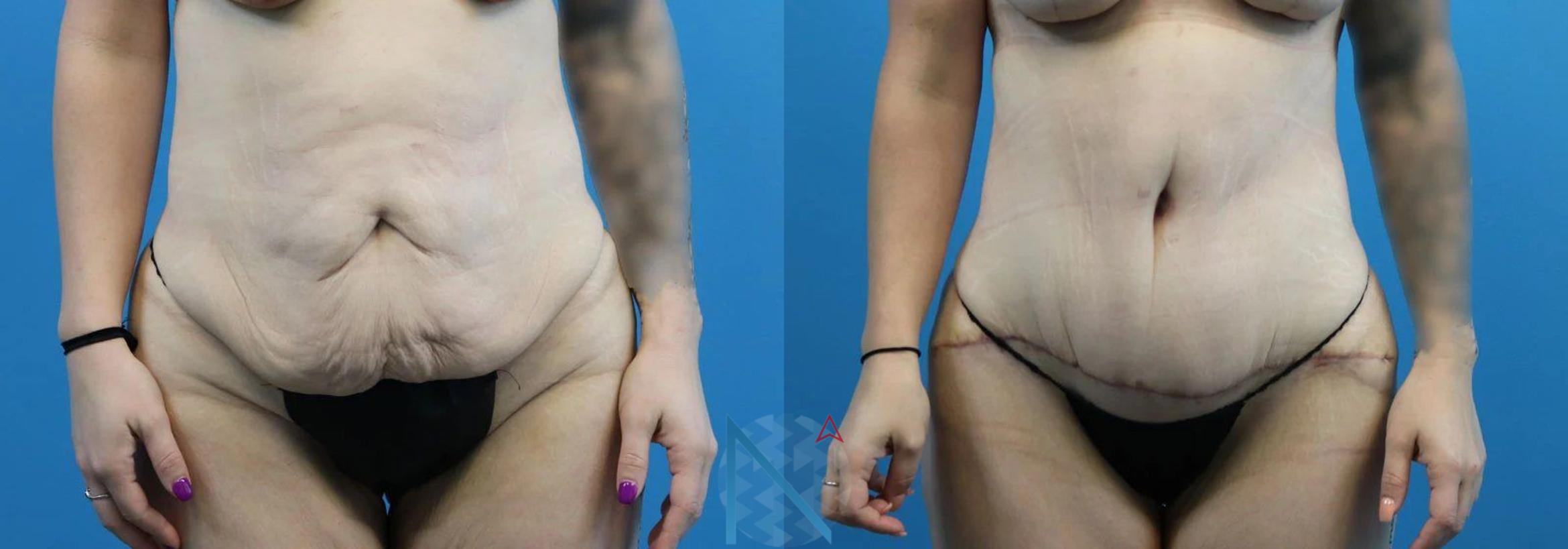 Before & After Tummy Tuck Case 121 View 1 View in Raleigh, NC