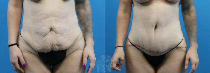 Before & After Tummy Tuck Case 121 View 1 View in Raleigh, NC