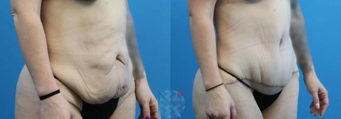 Before & After Tummy Tuck Case 121 View 2 View in Raleigh, NC