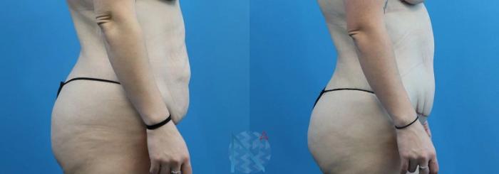 Before & After Tummy Tuck Case 121 View 3 View in Raleigh, NC