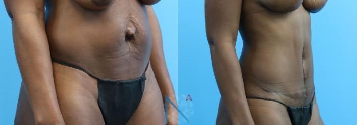 Before & After Tummy Tuck Case 122 View 2 View in Raleigh, NC