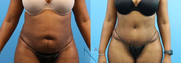 Before & After Tummy Tuck Case 123 View 1 View in Raleigh, NC