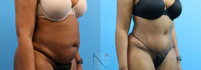 Before & After Tummy Tuck Case 123 View 2 View in Raleigh, NC