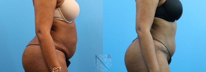 Before & After Tummy Tuck Case 123 View 3 View in Raleigh, NC