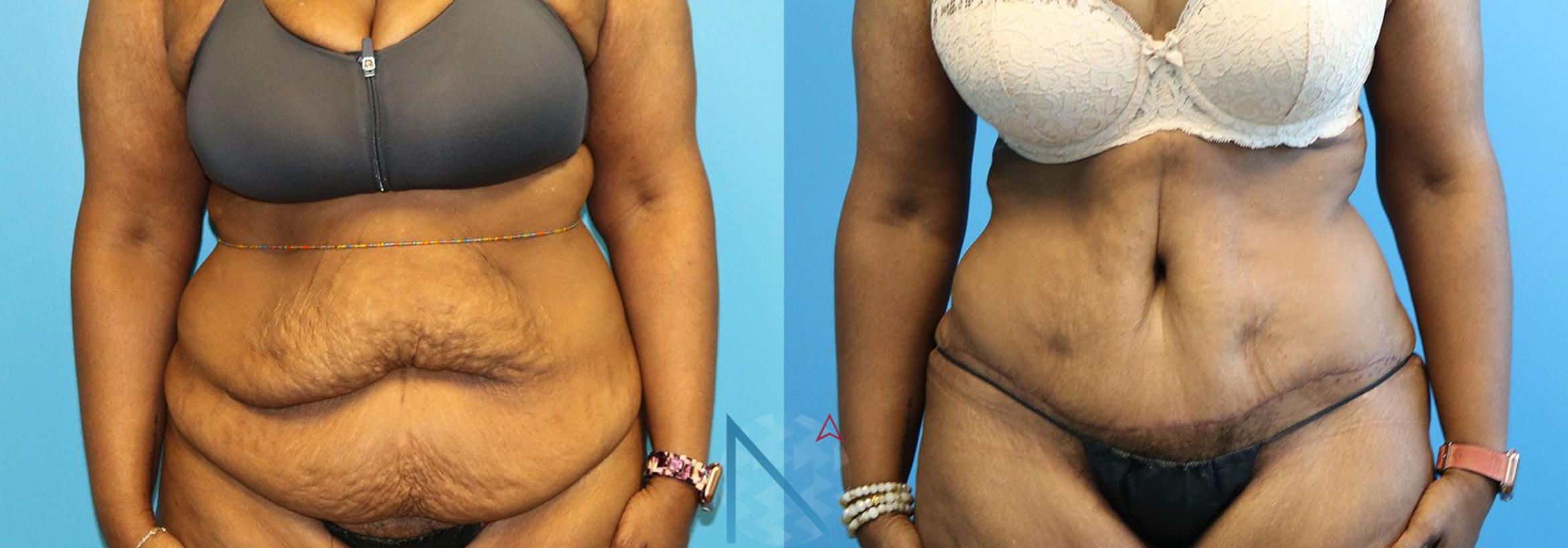 Before & After Tummy Tuck Case 124 View 1 View in Raleigh, NC