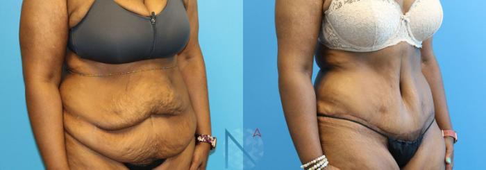 Before & After Tummy Tuck Case 124 View 2 View in Raleigh, NC