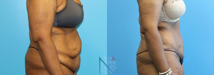 Before & After Tummy Tuck Case 124 View 3 View in Raleigh, NC