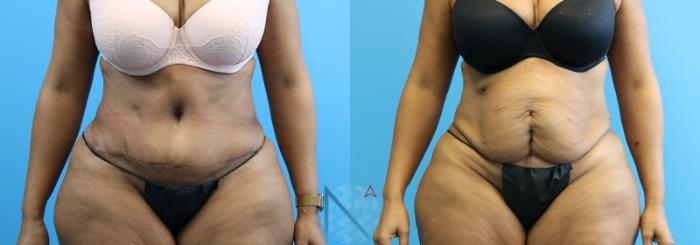 Before & After Tummy Tuck Case 125 View 1 View in Raleigh, NC