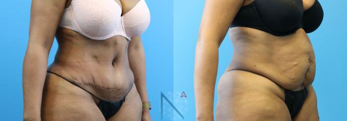 Before & After Tummy Tuck Case 125 View 2 View in Raleigh, NC