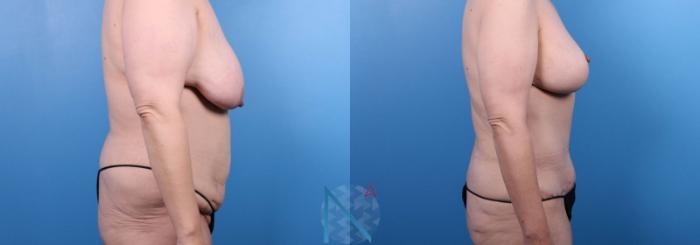 Before & After Tummy Tuck Case 126 View 3 View in Raleigh, NC