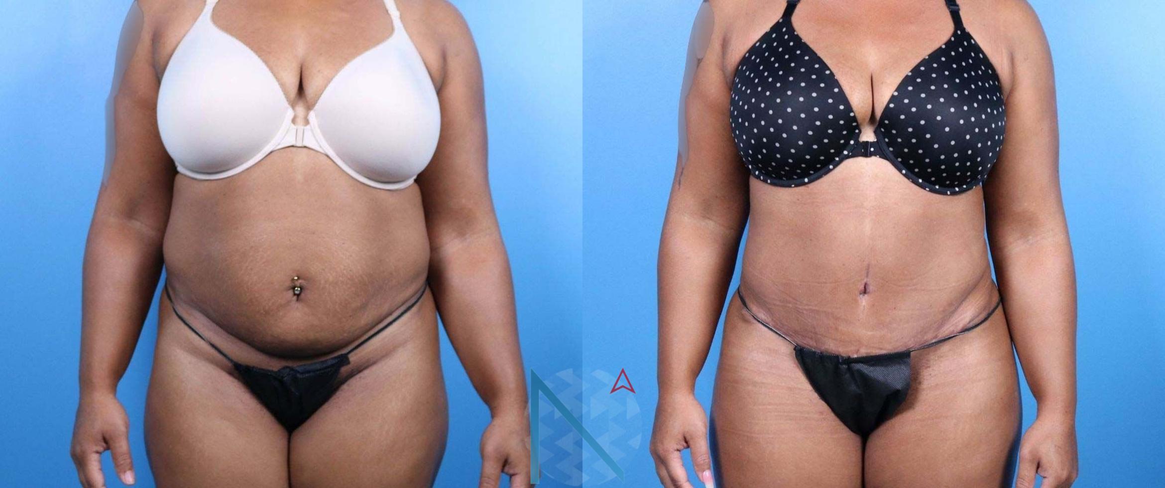 Before & After Tummy Tuck Case 127 View 1 View in Raleigh, NC